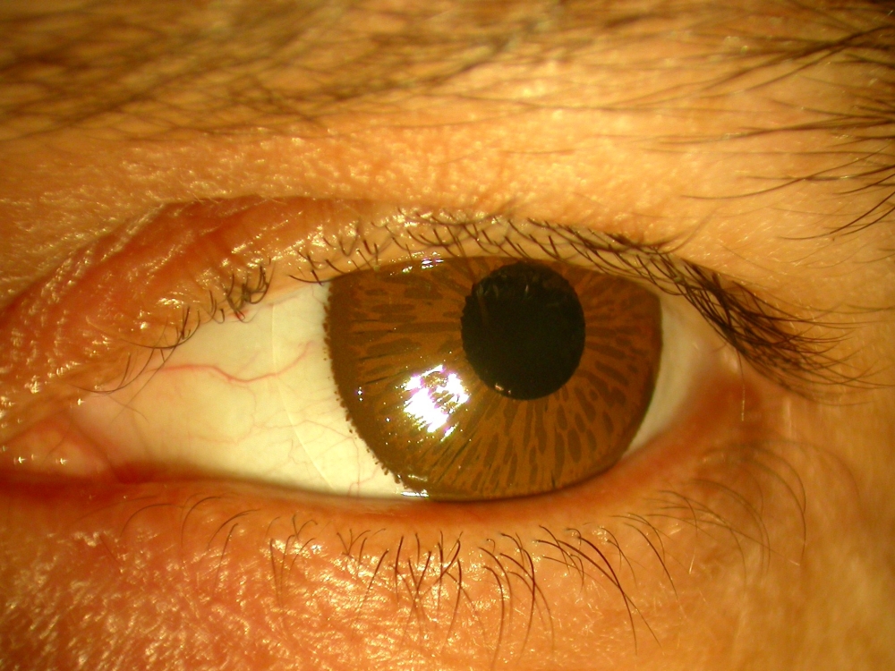 images/foto/wybrane_choroby_oczu/proteza galki ocznej.jpg